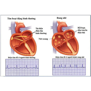 MÁY ĐO HUYẾT ÁP MICROLFIE B3 AFIB ADVANCE