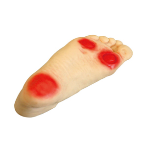 Mô hình điều dưỡng chân cho người bệnh tiểu đường