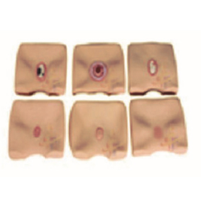 Mô hình hình thành vết loét