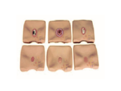 Mô hình hình thành vết loét