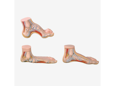 Mô hình bàn chân bình thường, bàn chân phẳng và bàn chân cong