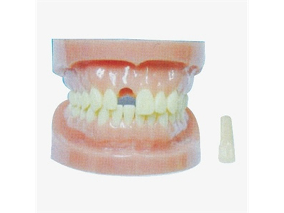 Mô hình răng tháo rời không cần chân răng