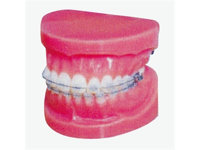 Mô hình chỉnh nha cố định