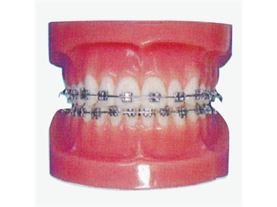 Mô hình chỉnh nha cố định (Normal)