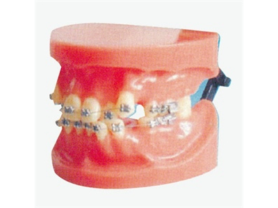 Mô hình chỉnh nha cố định (trật khớp)