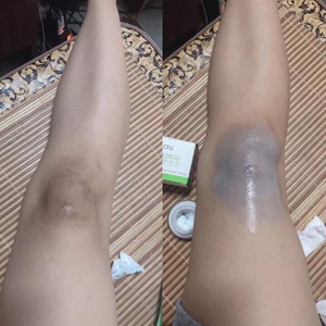 Kem làm mờ thâm OL-Cell Hàn Quốc