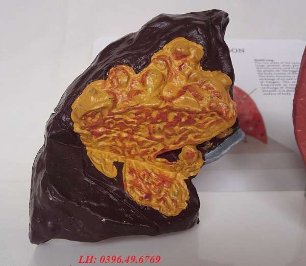 Mô hình bệnh lý phổi hay gặp