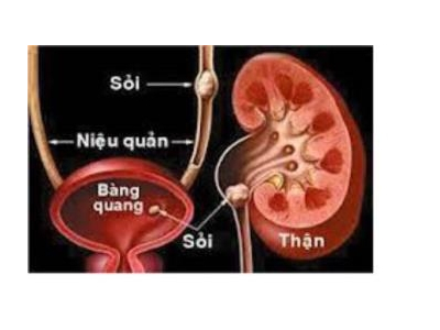 BỆNH LÝ SỎI THẬN VÀ CƠ CHẾ ĐIỀU TRỊ BẰNG ESWL
