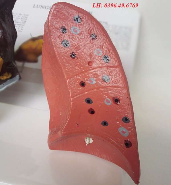 Mô hình giải phẫu bệnh lý phổi