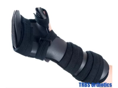 Nẹp chỉnh hình gãy bàn tay