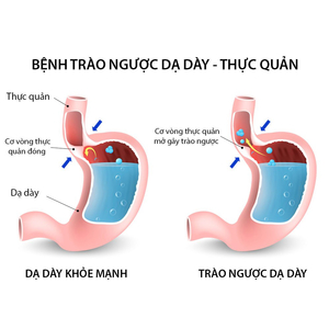 Dấu hiệu trào ngược dạ dày bạn nên biết!