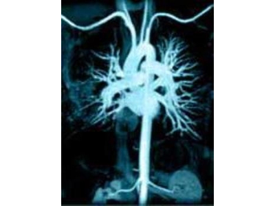 Kỹ thuật chụp X-quang mạch máu