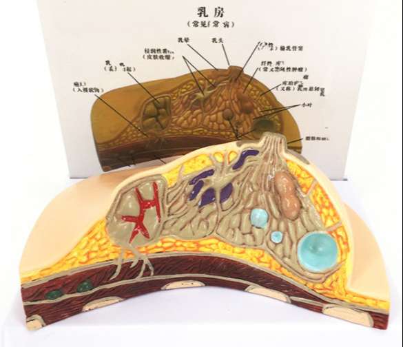 Mô hình tuyến vú bệnh lý