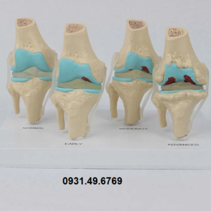MÔ HÌNH 4 GIAI ĐOẠN THOÁI HÓA KHỚP GỐI