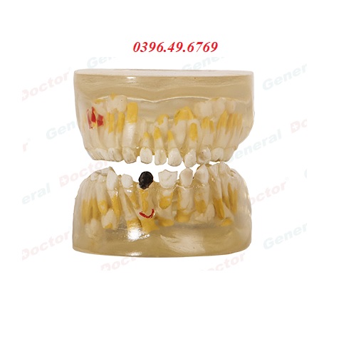 MÔ HÌNH BỆNH LÝ NHA KHOA TRONG SUỐT MODEL GD/B10011