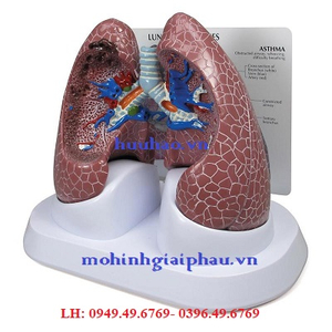 Mô hình bệnh lý phổi