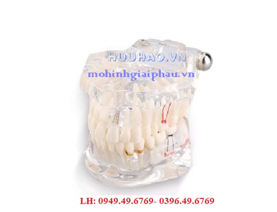 Mô hình bệnh lý răng người trong suốt