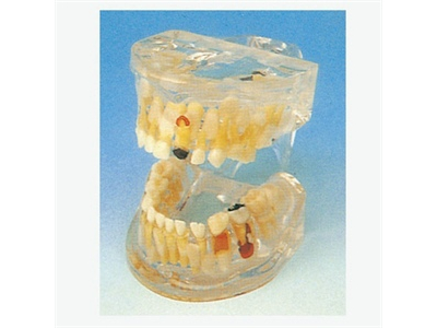 Mô hình bệnh lý răng sữa trong suốt