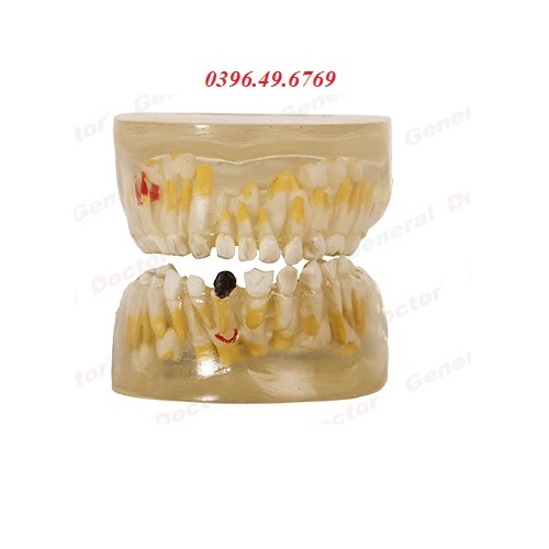 MÔ HÌNH BỆNH LÝ NHA KHOA TRONG SUỐT MODEL GD/B10011