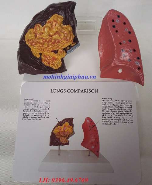 Mô hình bệnh lý phổi