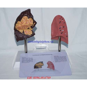 Mô hình bệnh lý về phổi