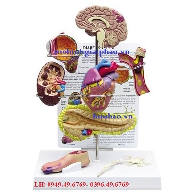 Mô hình biến chứng tiểu đường giai đoạn 2