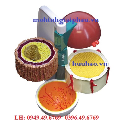 Mô hình các biến chứng của bệnh tiểu đường