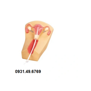 MÔ HÌNH ĐẶT VÒNG TRÁNH THAI HONGLIAN GD/F5N