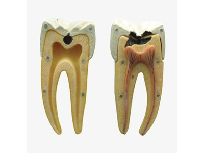 Mô hình sâu răng