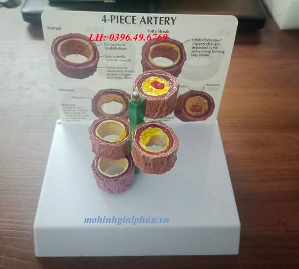 Mô hình các giai đoạn xơ vữa động mạch