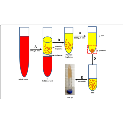 Quy trình iPSC-PRP-KIT . Lấy máu tự thân, huyết tương giàu tiểu cầu PRP