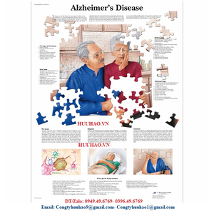 Tranh, Biểu đồ bệnh Alzheimer